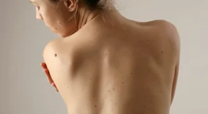 Cilt Sağlığında Dikkat Çeken Artış: Melanoma Vakaları Neden Yükseliyor?