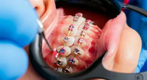 Diş Teli Yaptırmadan Önce Bilinmesi Gerekenler